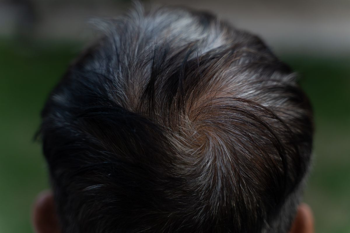 Why Hair Thinning Happens and What You Can Do Early